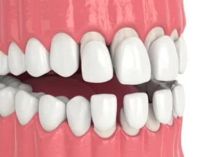 upper and lower teeth aligners