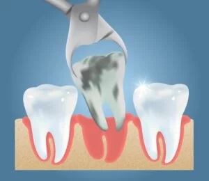 rotten tooth extraction
