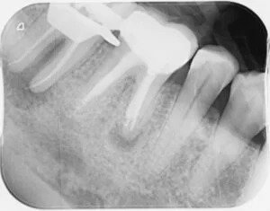 xray of teeth canal